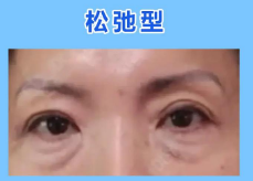 去眼袋手术