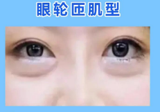 去眼袋手术