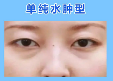 去眼袋手术