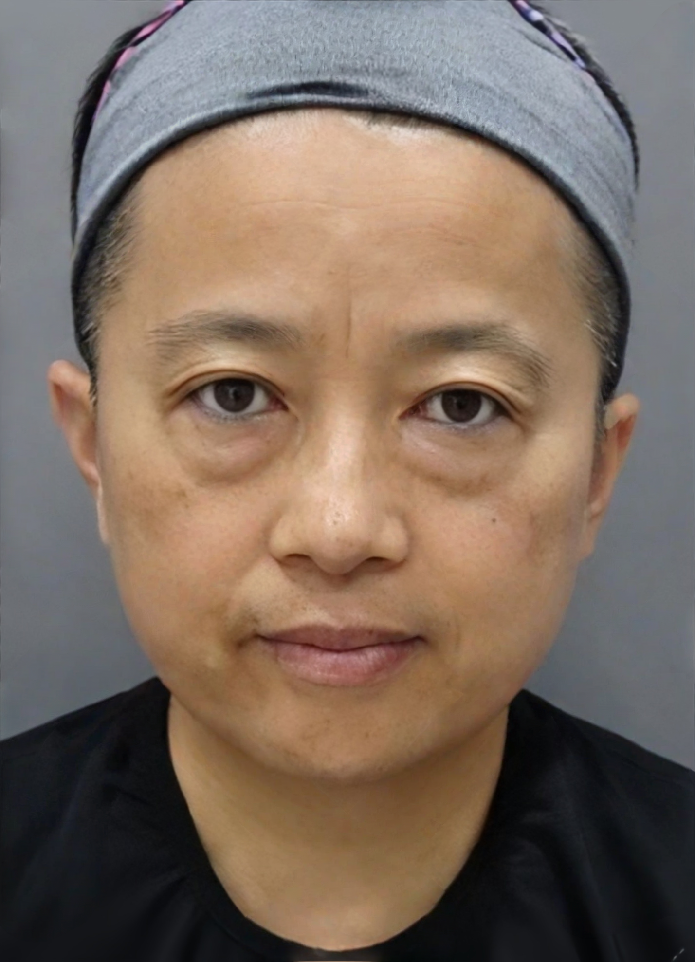 去眼袋手术