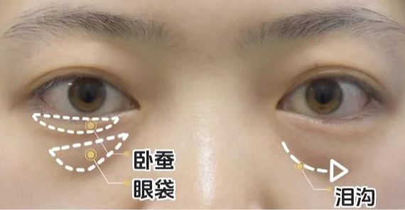 眼袋