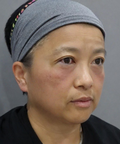 去眼袋手术