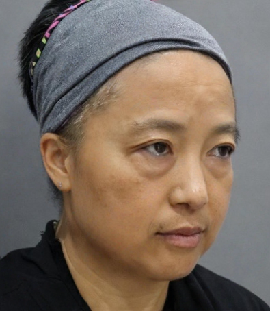 去眼袋手术