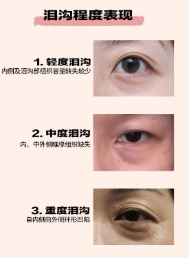 眼袋
