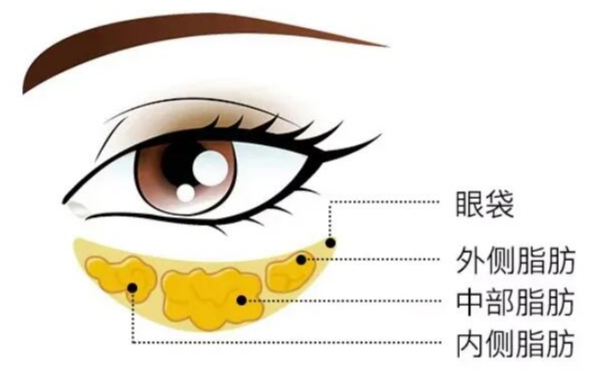 眼袋