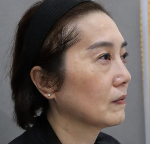 去眼袋手术