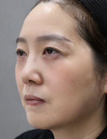 去眼袋手术