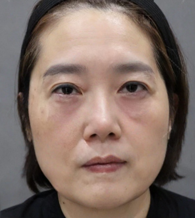 去眼袋手术