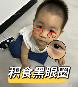 去眼袋手术