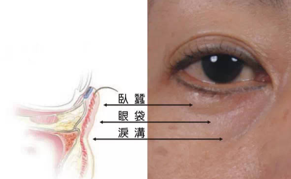 眼袋