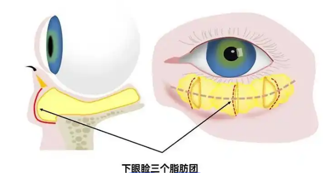 眼袋