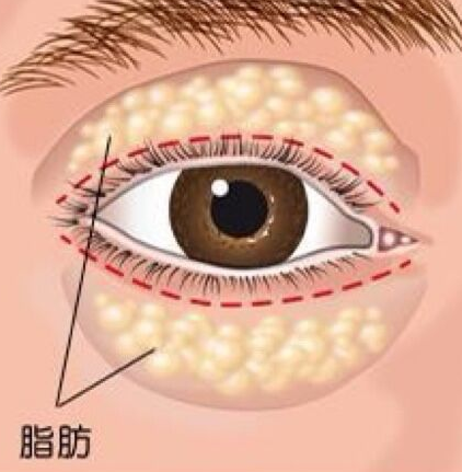眼袋