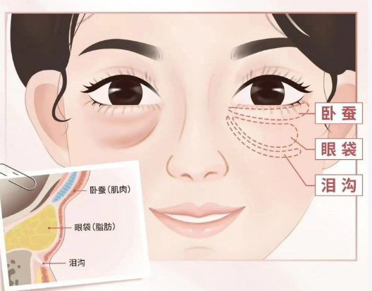 眼袋