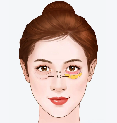 眼袋