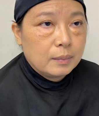 去眼袋手术