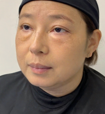 去眼袋手术
