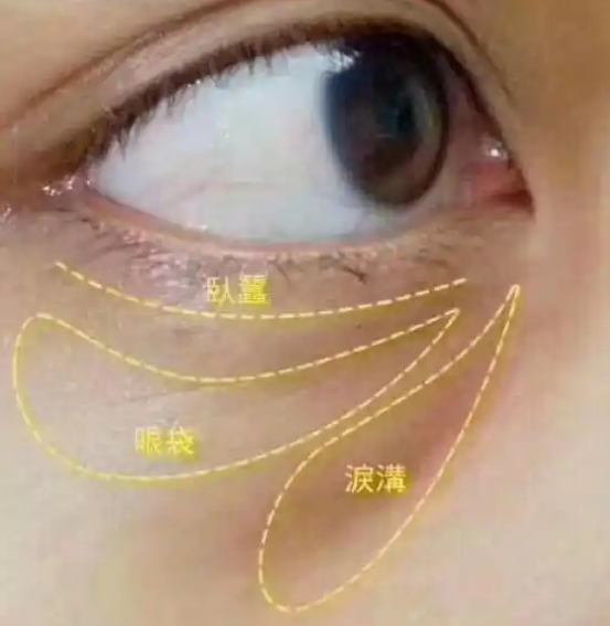 去眼袋手术