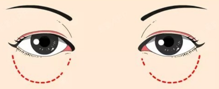 眼袋