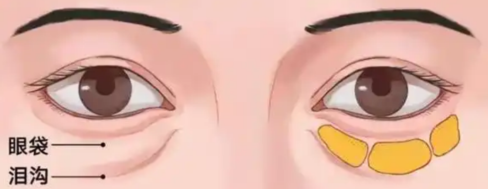 眼袋