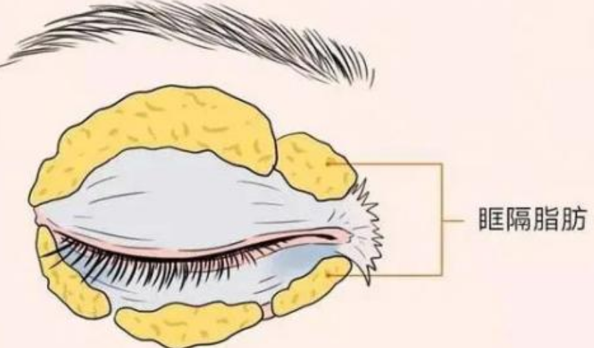 眼袋