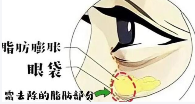 眼袋