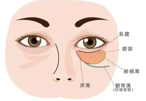 眼袋