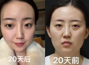 眼袋