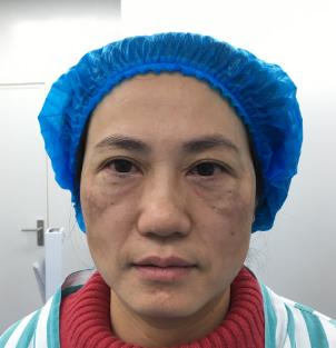 去眼袋手术