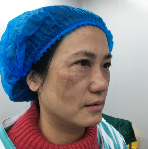 去眼袋手术
