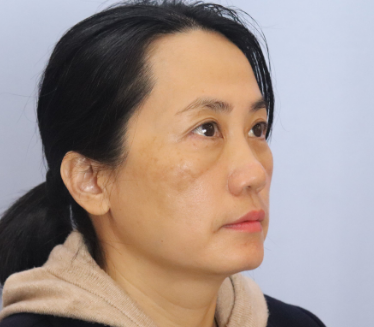 去眼袋手术