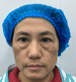 去眼袋手术