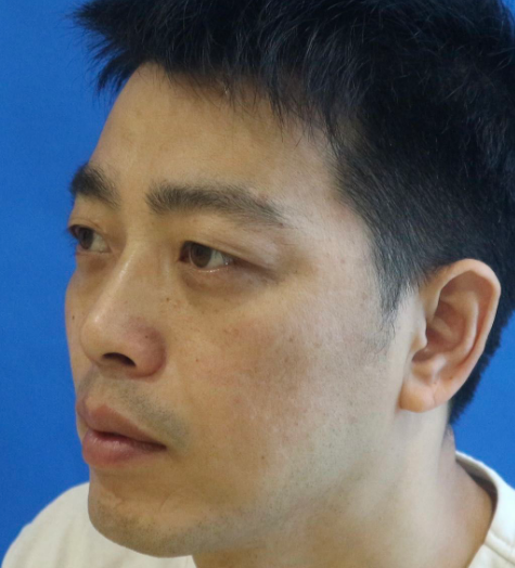 去眼袋手术
