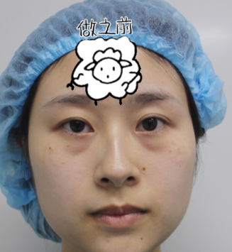 去眼袋手术
