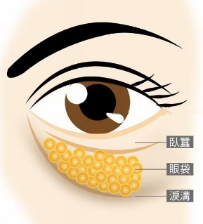 去眼袋手术
