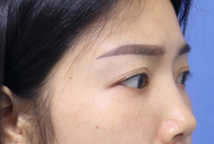 去眼袋手术