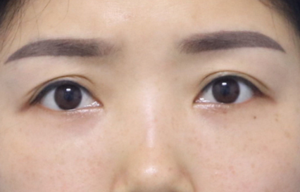 去眼袋手术
