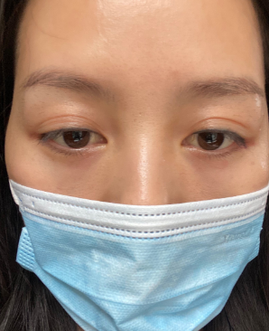 去眼袋手术