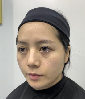 去眼袋手术