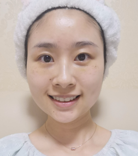 去眼袋手术