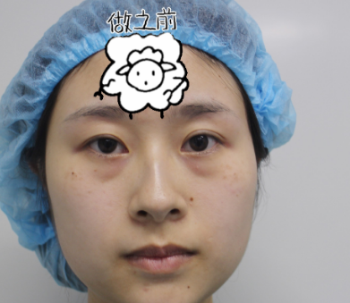 去眼袋手术