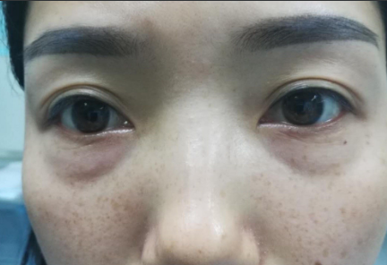 去眼袋手术