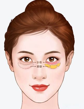 眼袋