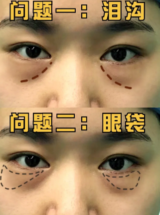 去眼袋手术
