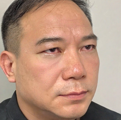 去眼袋手术