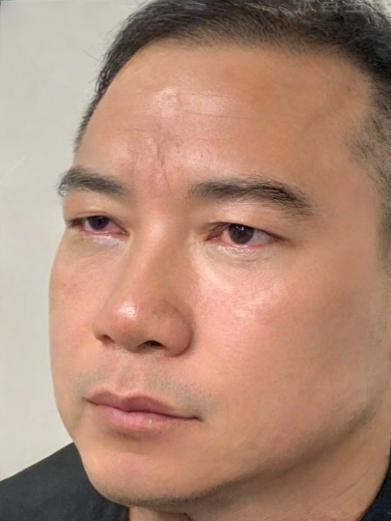 去眼袋手术