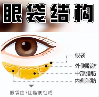去眼袋手术