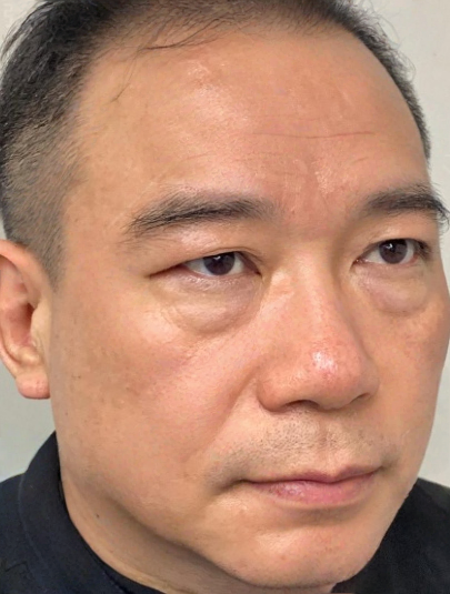 去眼袋手术