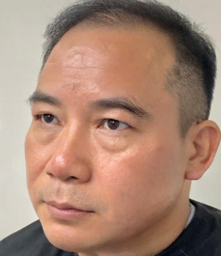 去眼袋手术