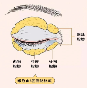 去眼袋手术