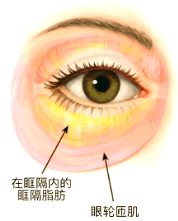 去眼袋手术